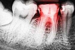 X-Ray of a tooth cavity
