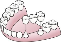 implant supported bridge in Davidsonville MD