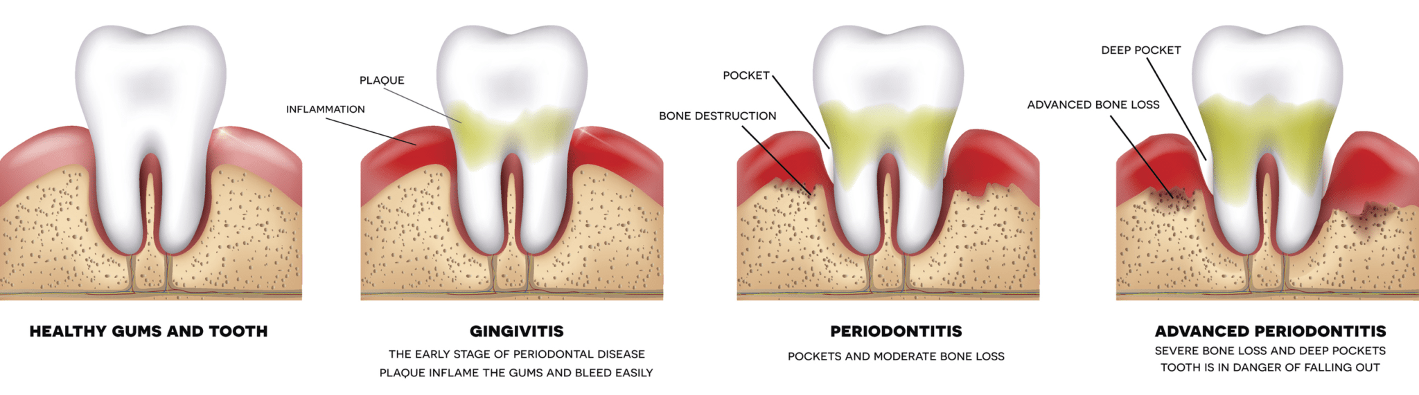 Bleeding gums treatment in Davidsonville MD