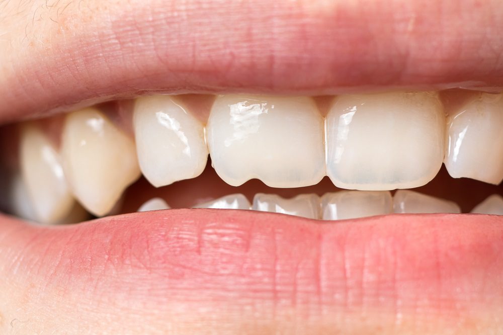 PORCELAIN VENEERS in DAVIDSONVILLE MD could help shape your teeth, but they aren't the only option